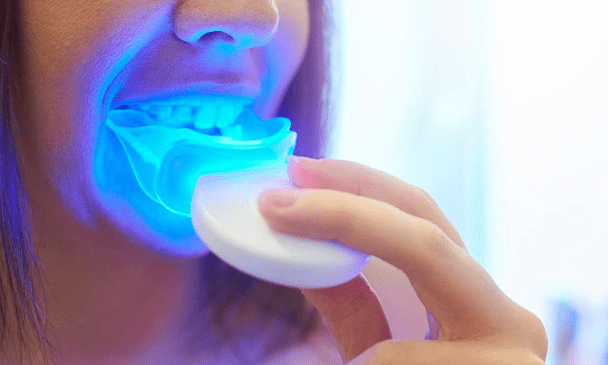 Teeth Whitening Work
