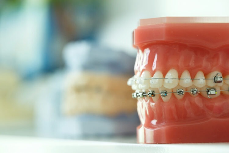 Common Issues Associated With An Underbite